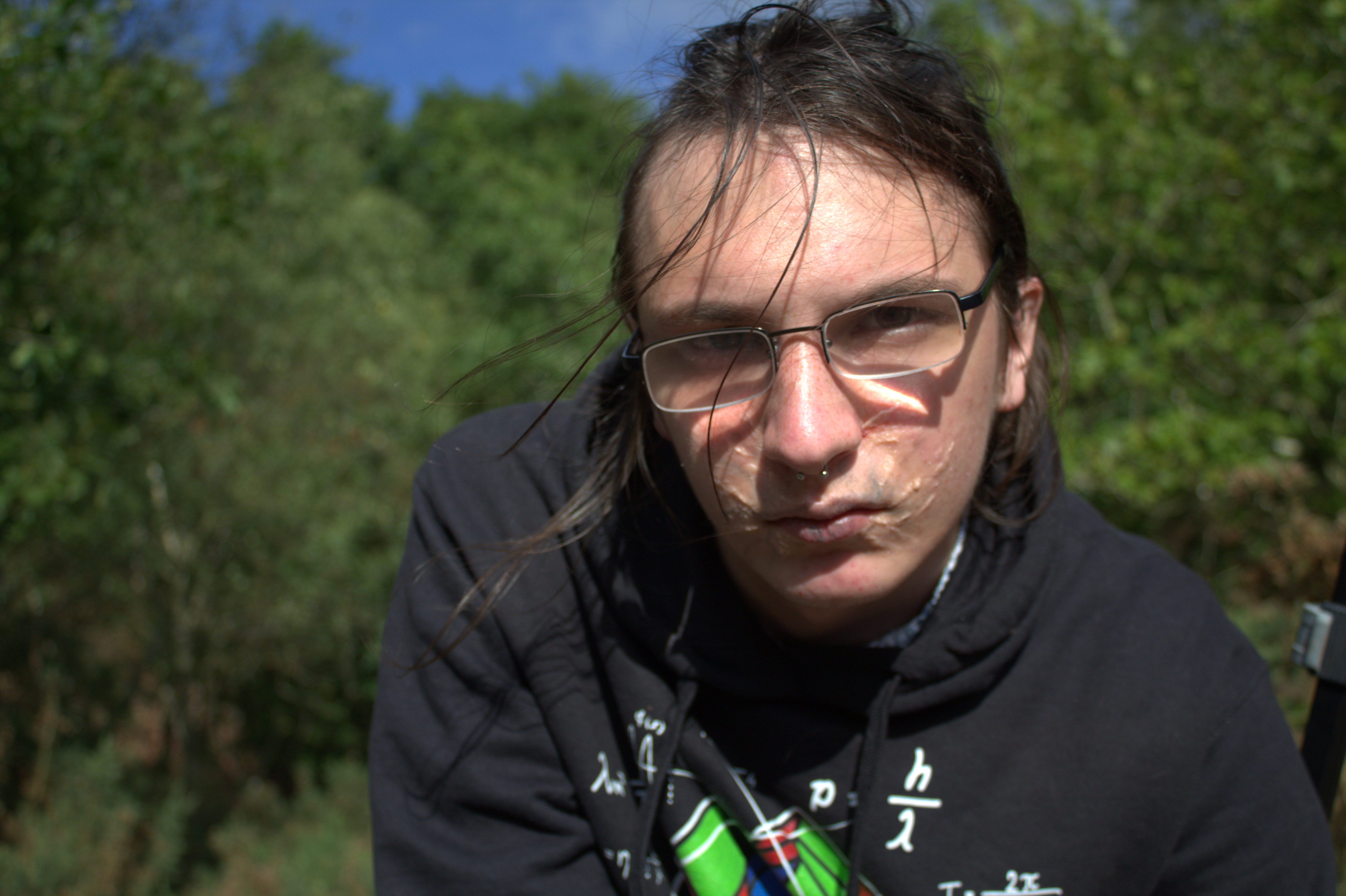 Joseph Rutland with glasses and skin lesions
